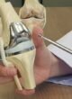 Best Knee Replacement Surgery in Delhi
