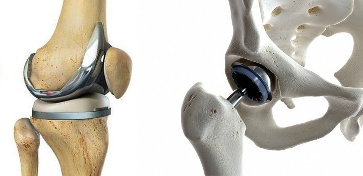 Joint Replacement Surgeon in Narela