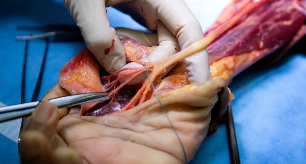 Hand Amputation Surgeon in Narela Hand Amputation Surgeon in Narela