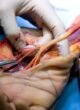 Hand Amputation Surgeon in Narela