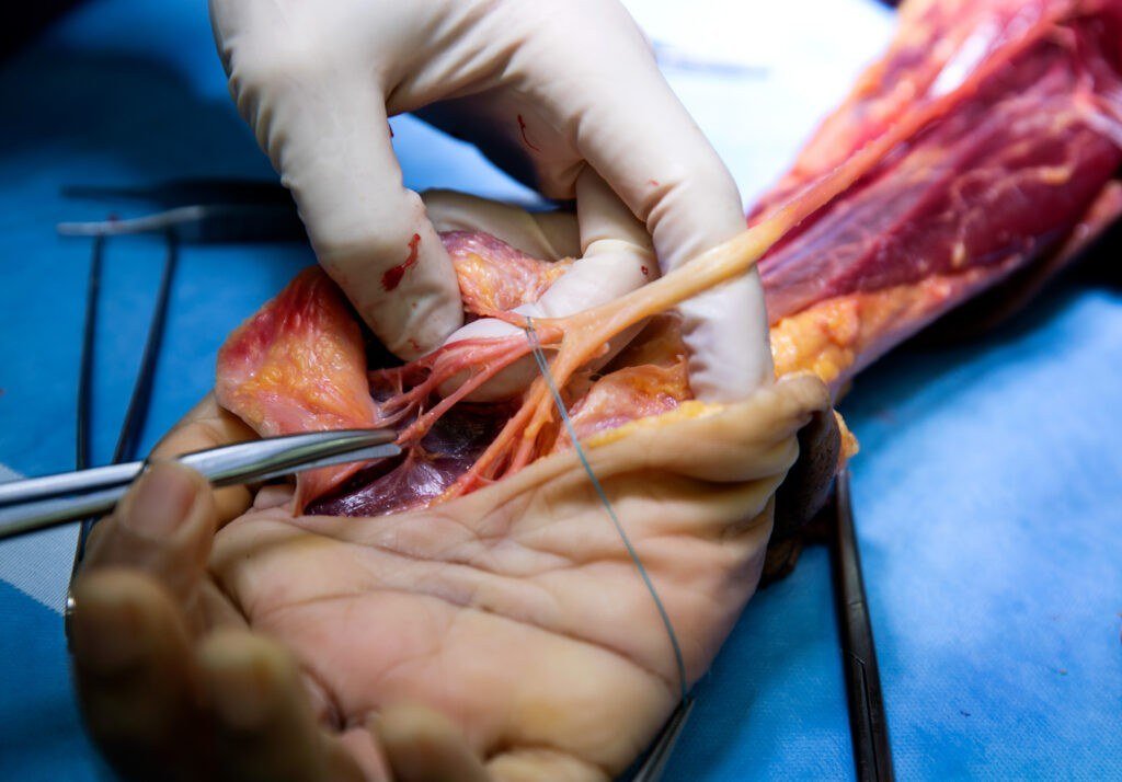 Hand Amputation Surgeon in Narela