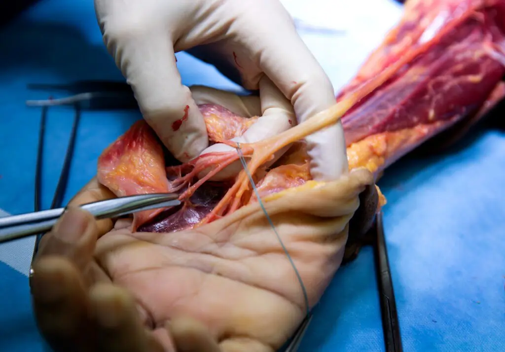 Hand Amputation Surgeon in Narela