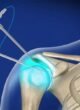 Shoulder Replacement Surgeon in Narela