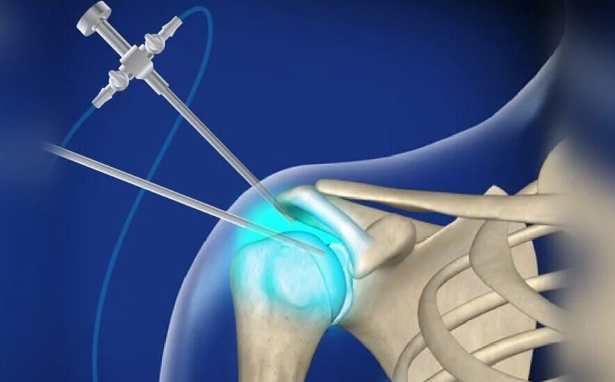 Shoulder Replacement Surgeon in Narela