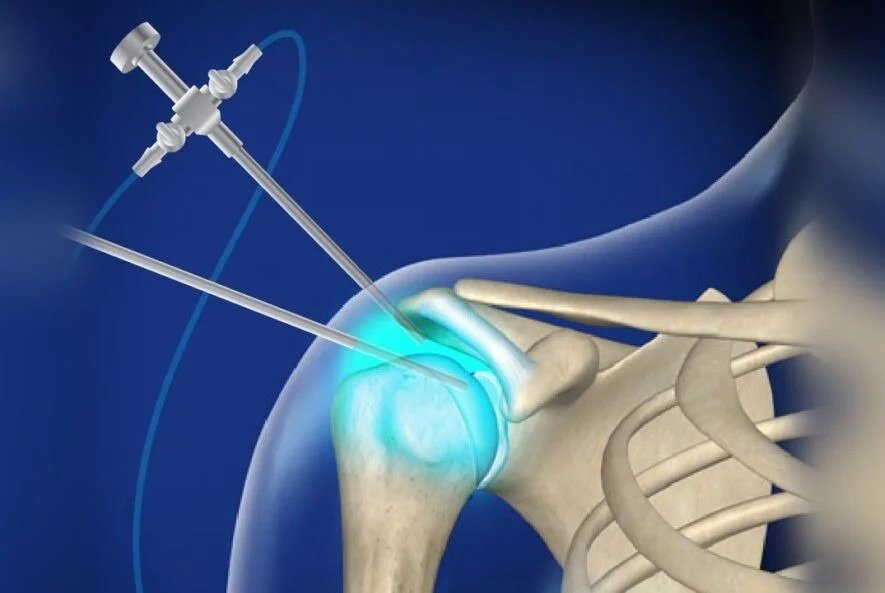 Shoulder Replacement Surgeon in Narela