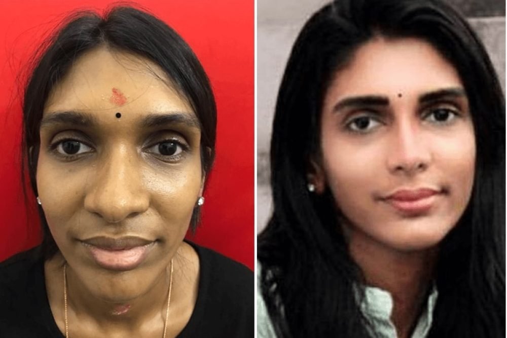 before-and-after-rhinoplasty-surgeon-in-india