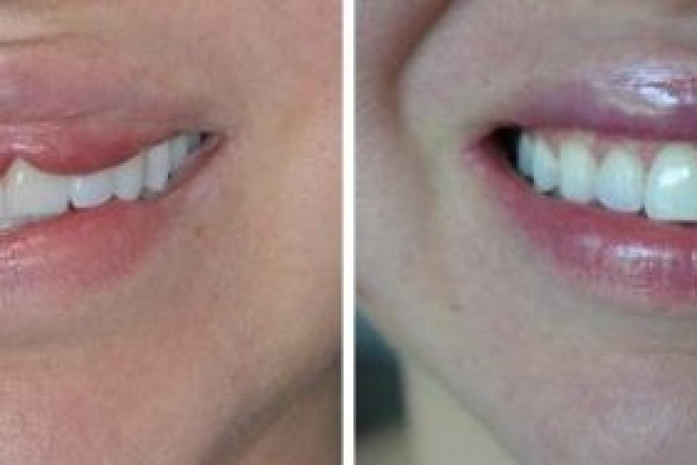 lip-reduction-before-after-10-570x188
