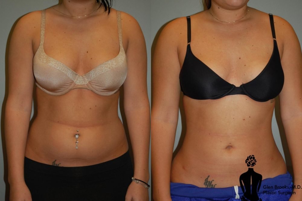 liposuction-84-view-1-detail