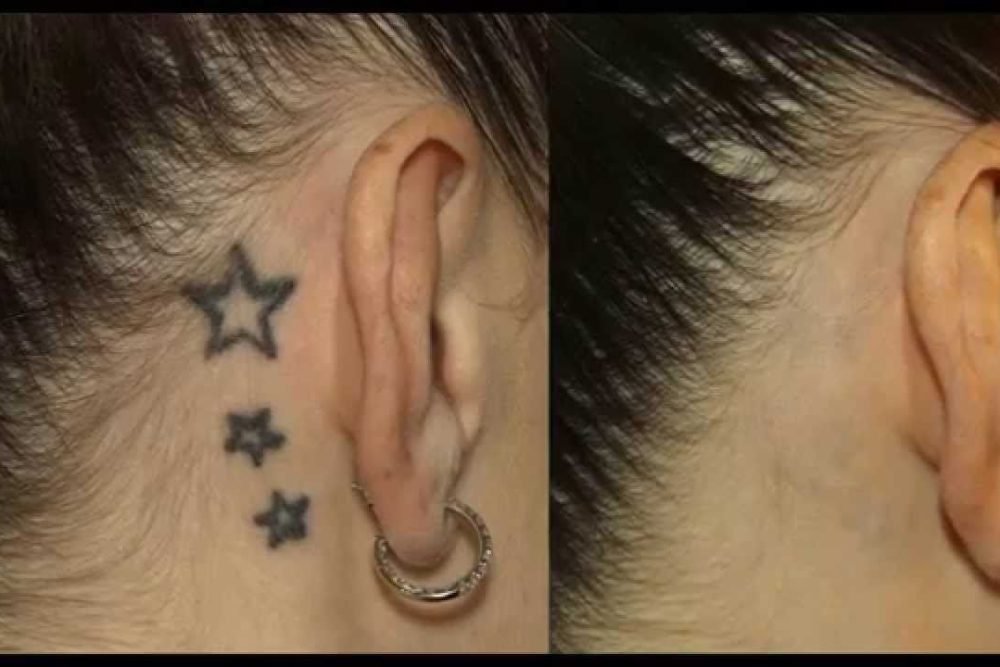 tattoremoval